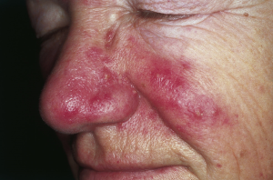 Selecting the Best Treatment for Rosacea