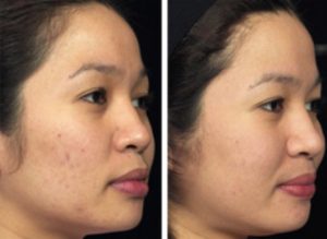 Successful Treatment of Acne Scars in People of Asian Descent